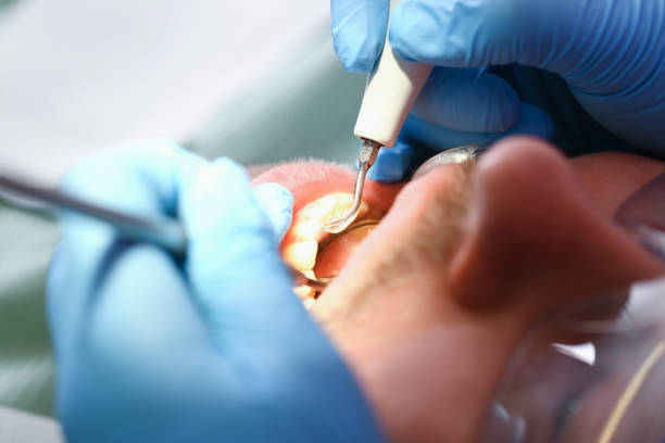 Best Knocked-Out Tooth (Avulsed Tooth) Treatment in Laurinburg, NC